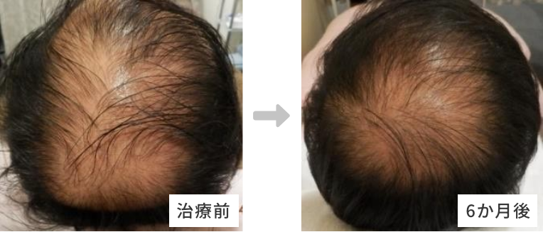 50代男性AGA（男性型脱毛症）