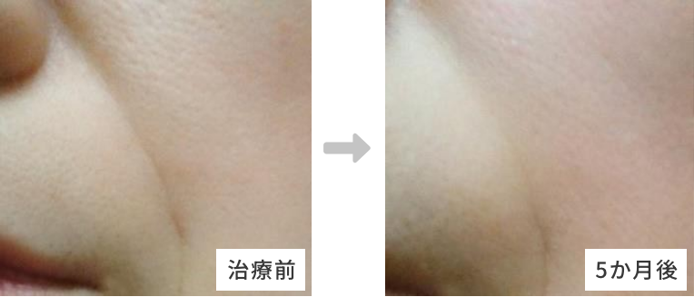 50代女性ほうれい線